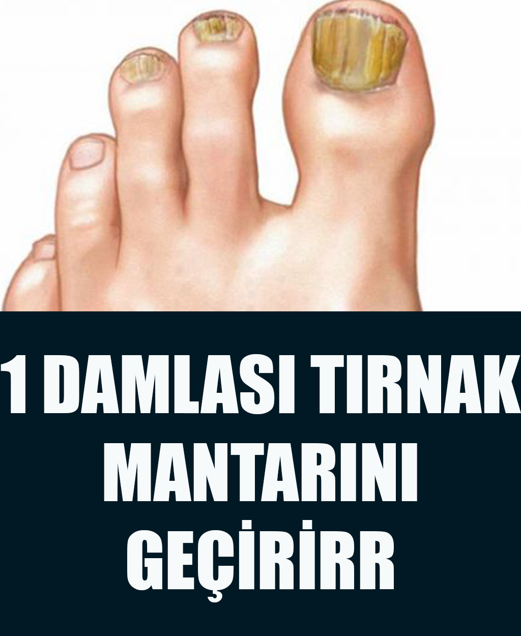 Basit Bir Yöntemle Tırnak Mantarından Kurtulun	 - 1
