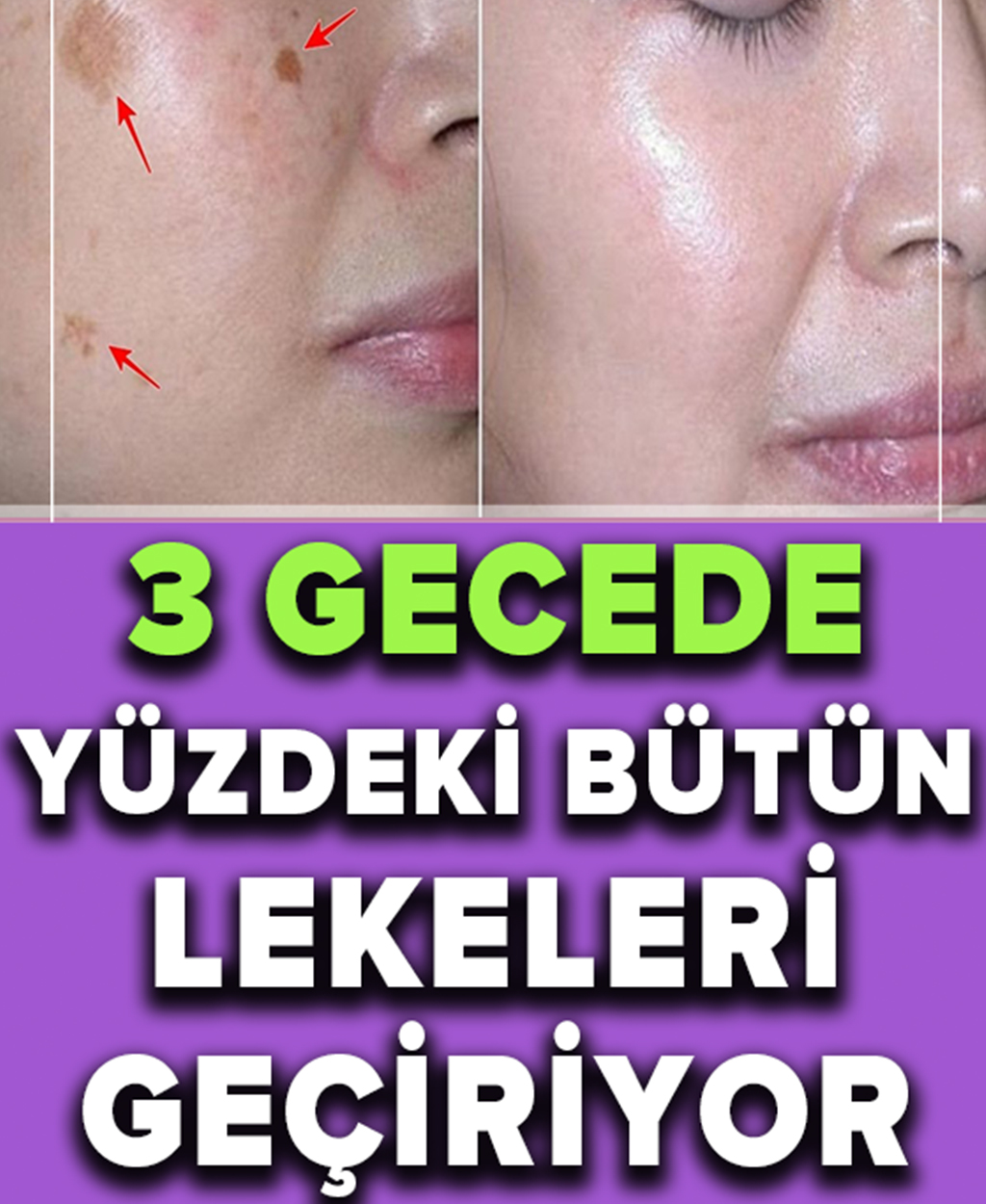 İki Malzemeli Bu Tarif Yüzünüzdeki Lekeleri 3 Gecede Geçiriyor - 1
