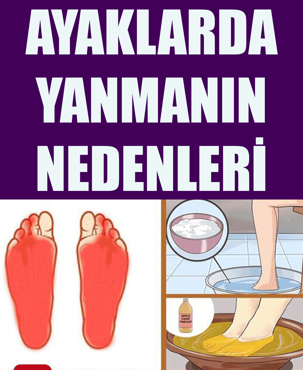 Ayaklarda Yanma Nedenleri - 1