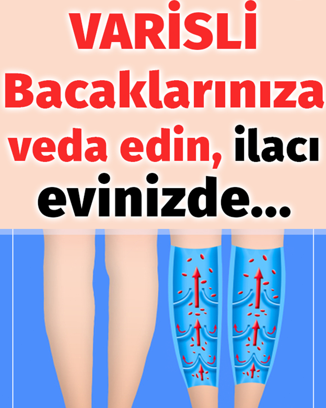 Varisli Damarlardan Kurtulmak İçin Doğal Çözümler - 1
