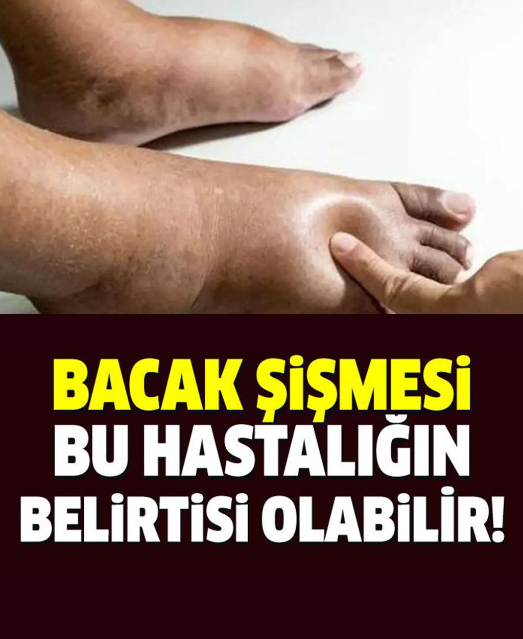 Bacak Şişmesi Bu Hastalığın Belirtisi Olabilir - 1