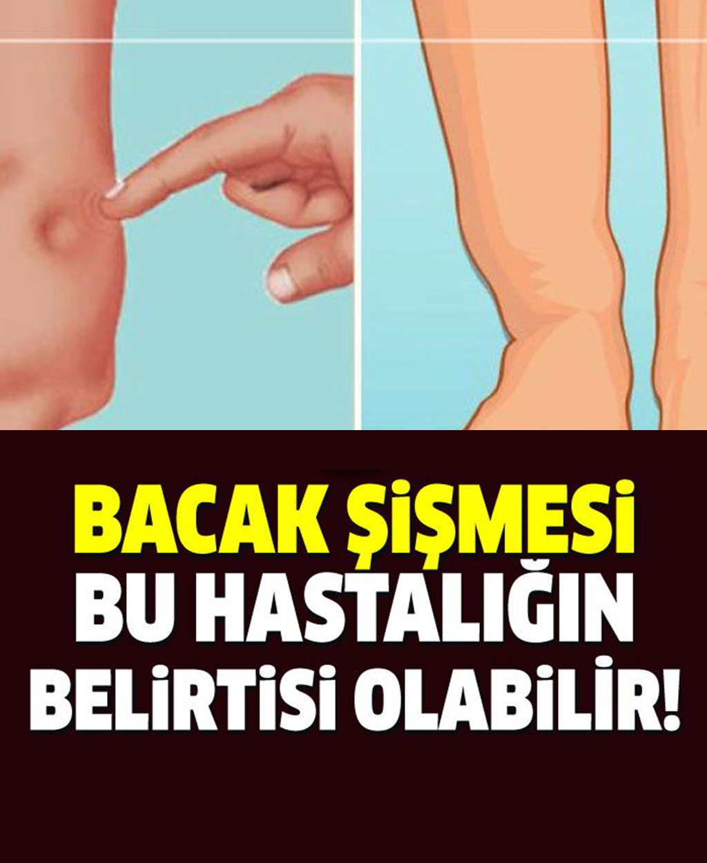 Ayak Bacak Şişmesi Neyin Belirtisi - 1