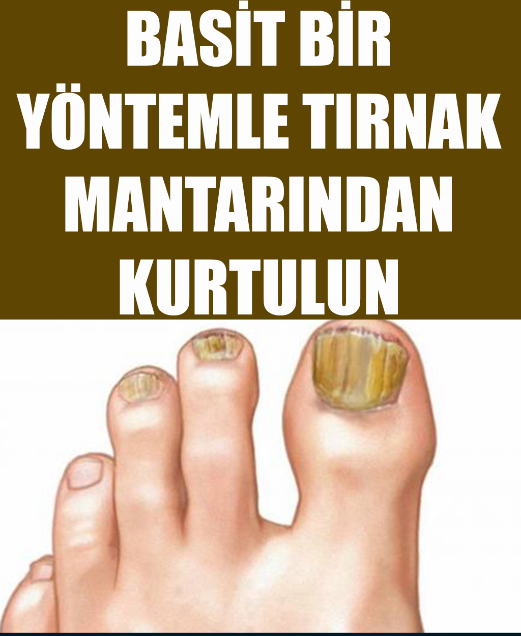 Basit Bir Yöntemle Tırnak Mantarından Kurtulun	 - 1