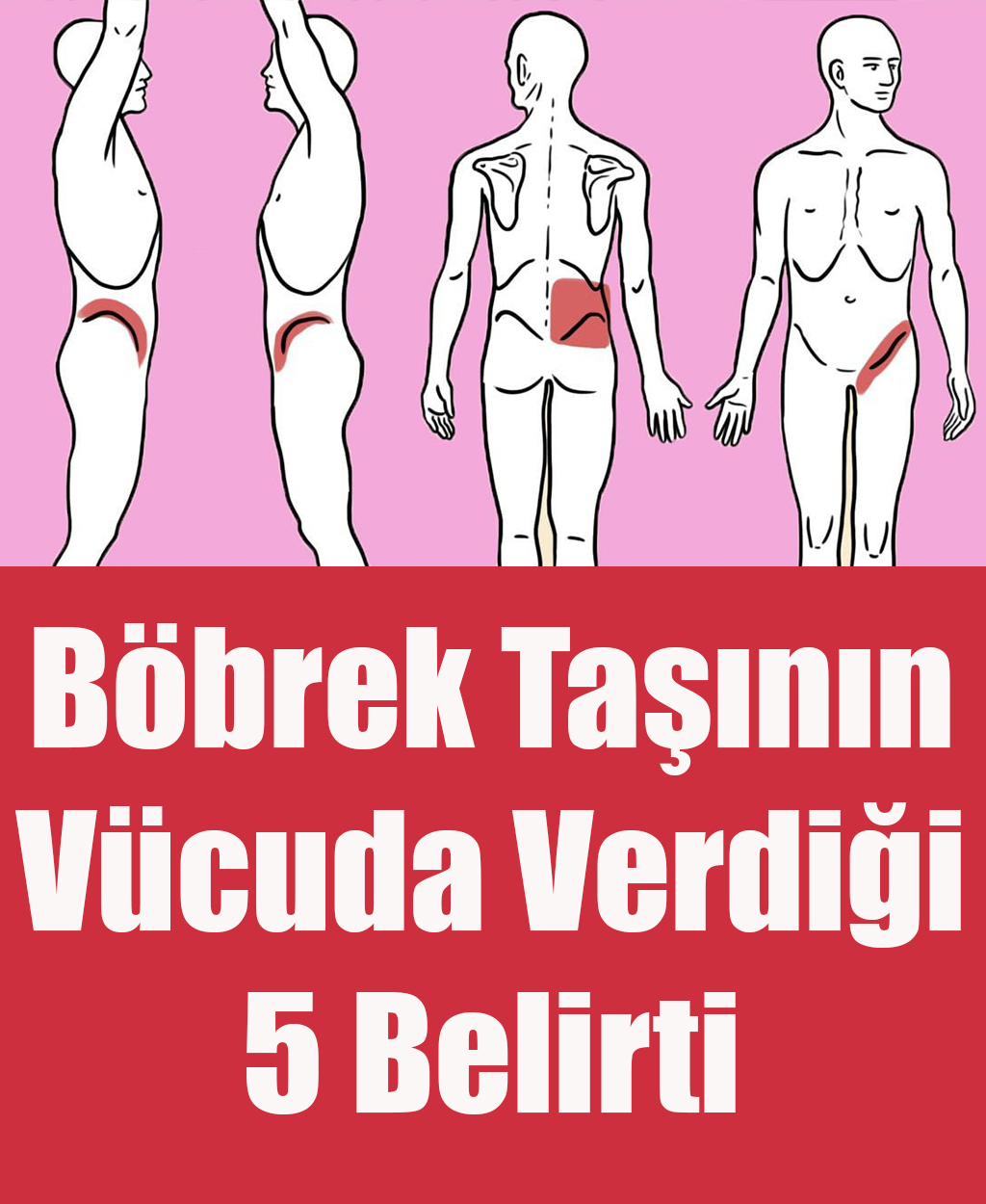 Böbrek Taşının Vücuda Verdiği 5 Belirti	 - 1