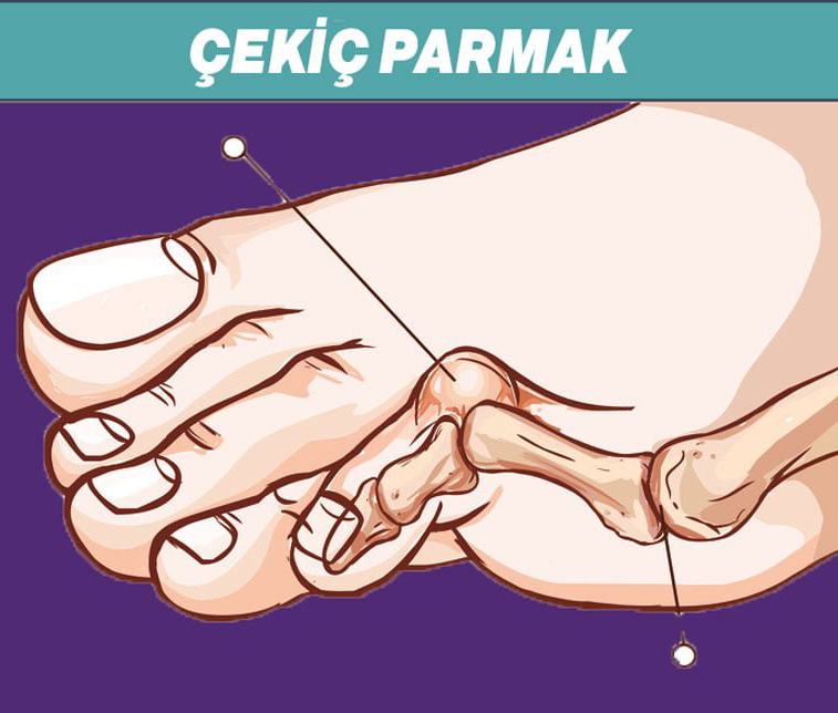 Topuklu Ayakkabının Zararlarını Bilseniz Tutup Fırlatırsınız - 2