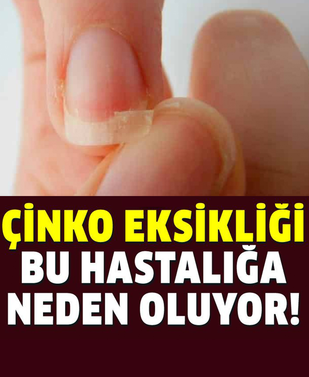 Çinko Eksikliği Bu Hastalığa Neden Oluyor - 1