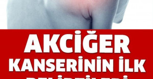 Akciğer Kanserinin Belirtilerini Öğrenin ve Önlemlerini Alın