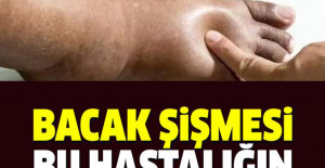 Bacak Şişmesi Bu Hastalığın Belirtisi Olabilir