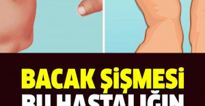 Ayak Bacak Şişmesi Neyin Belirtisi