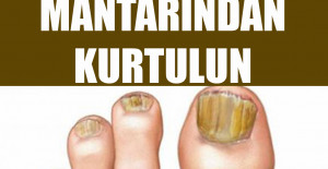 Basit Bir Yöntemle Tırnak Mantarından Kurtulun	
