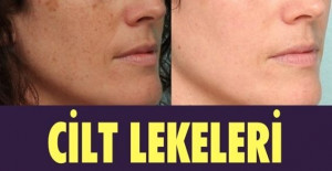 Cilt Lekeleri için En İyi Leke Giderici Kremler 