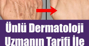 Ünlü Dermatoloji Uzmanın Tarifi İle Ciltteki Lekelerden Kurtulun