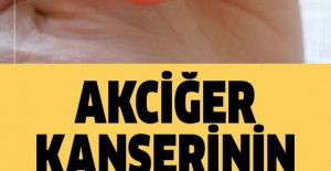 Akciğer Kanserinin En Sinsi 9 Bulgusu