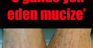 Eldeki lekeleri 3 günde yok eden mucize	