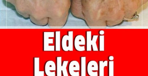 Eldeki lekeleri 3 günde yok eden mucize