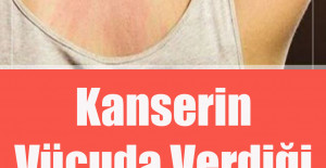 Kanserin Vücuda Verdiği 9 Belirti	