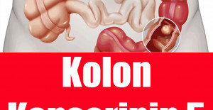 Kolon Kanserinin 5 Belirtisi