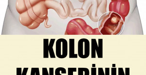 Kolon Kanserinin 5 Belirtisi