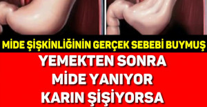 Yemekten Sonra Mide Şişiyorsa