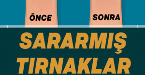 Sararan Tırnaklara Ne İyi Gelir