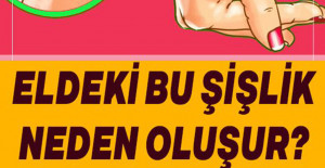 Bilekteki Bu Şişlik Neden Oluşur