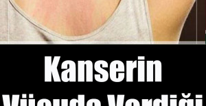 Kanserin Vücuda Verdiği 10 Belirti