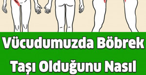 Vücudumuzda Böbrek Taşı Olduğunu Nasıl Anlarız