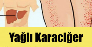 Yağlı Karaciğer Hastalığı Belirtileri