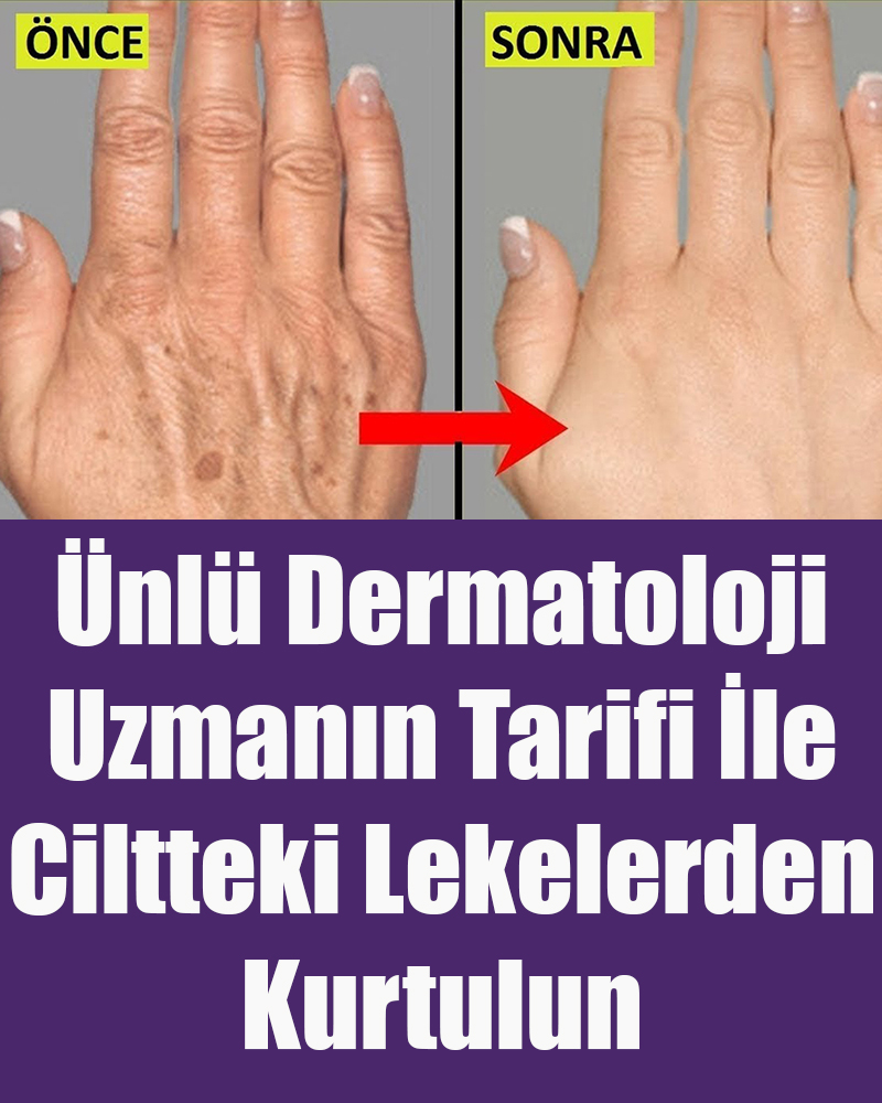 Ünlü Dermatoloji Uzmanın Tarifi İle Ciltteki Lekelerden Kurtulun - 1