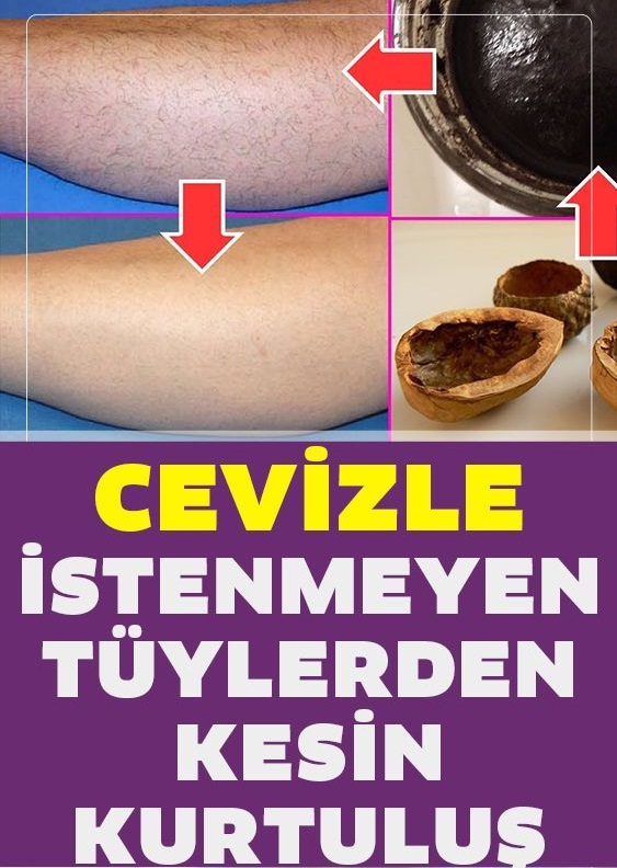 Cevizle İstenmeyen Tüylerden Kurtulmanın Kesin Yolu - 1
