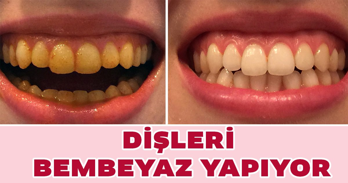 Hiç Bir Şey Komşumun Verdiği Tarif Kadar Dişlerimi Beyazlatmadı - 2
