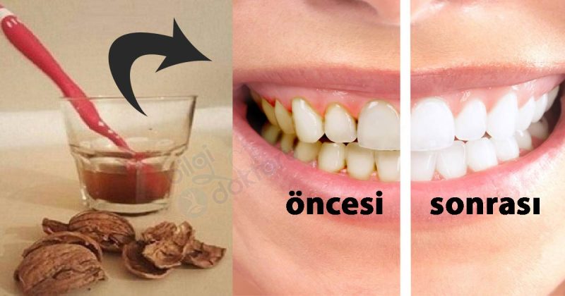 Diş Taşlarının Temizliğinin En Kolay 3 Yolu - 3