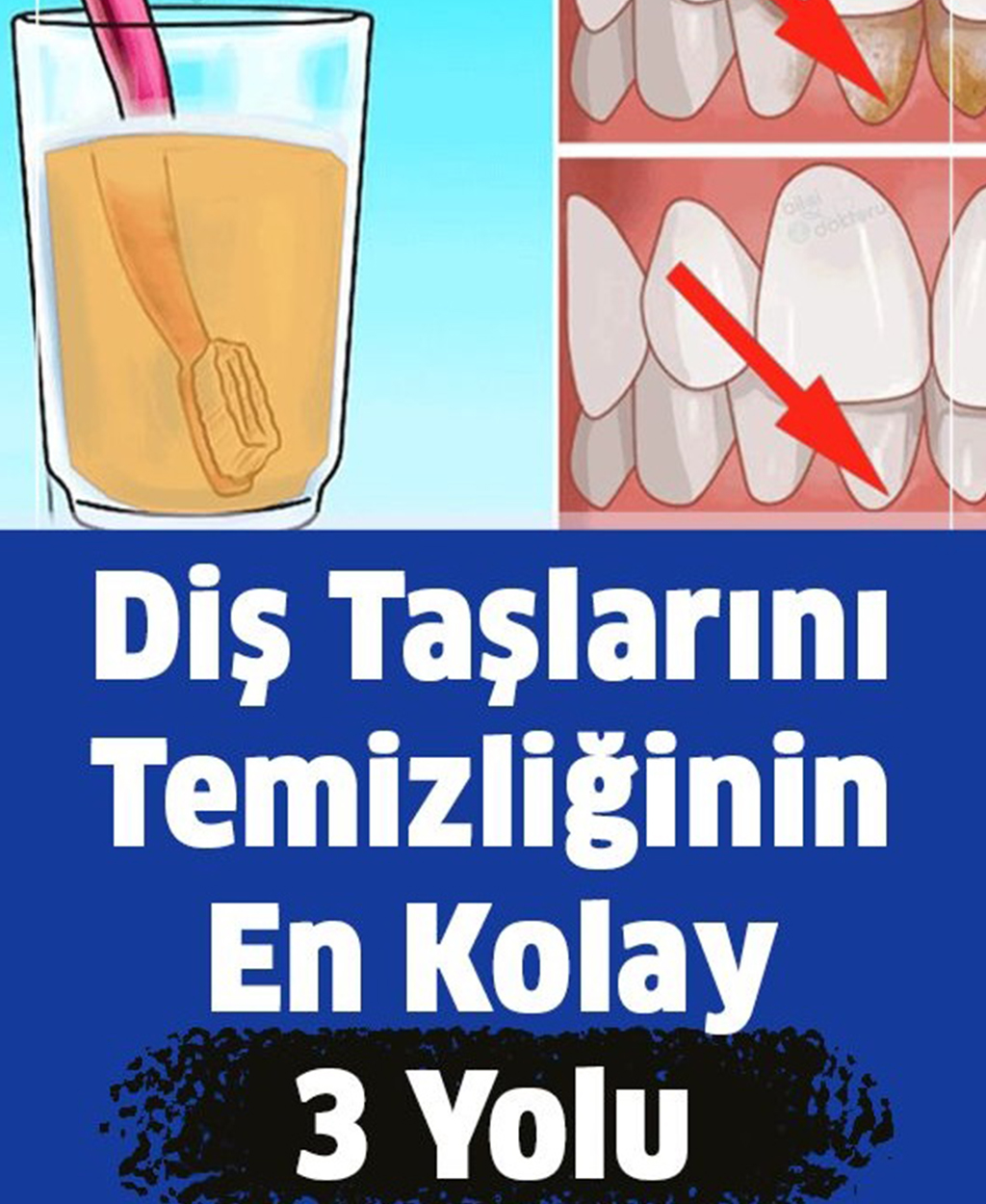 Diş Taşlarının Temizliğinin En Kolay 3 Yolu - 1
