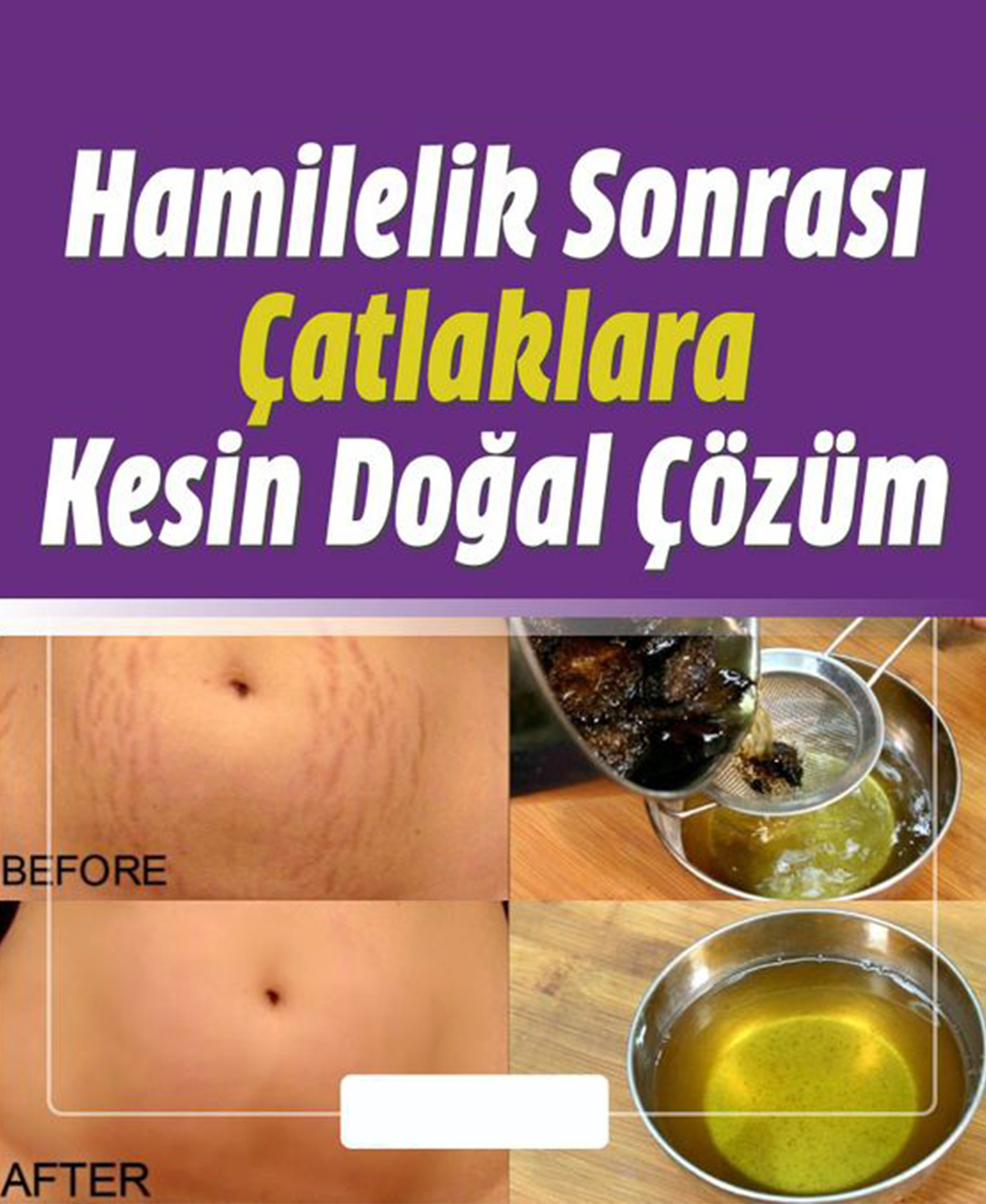 Doğum Çatlakları Nasıl Geçer? Ne İyi Gelir? - 1