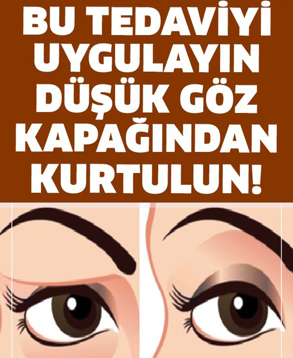 Bunu Uygulayın ve Düşük Göz Kapaklarından Kurtulun - 1