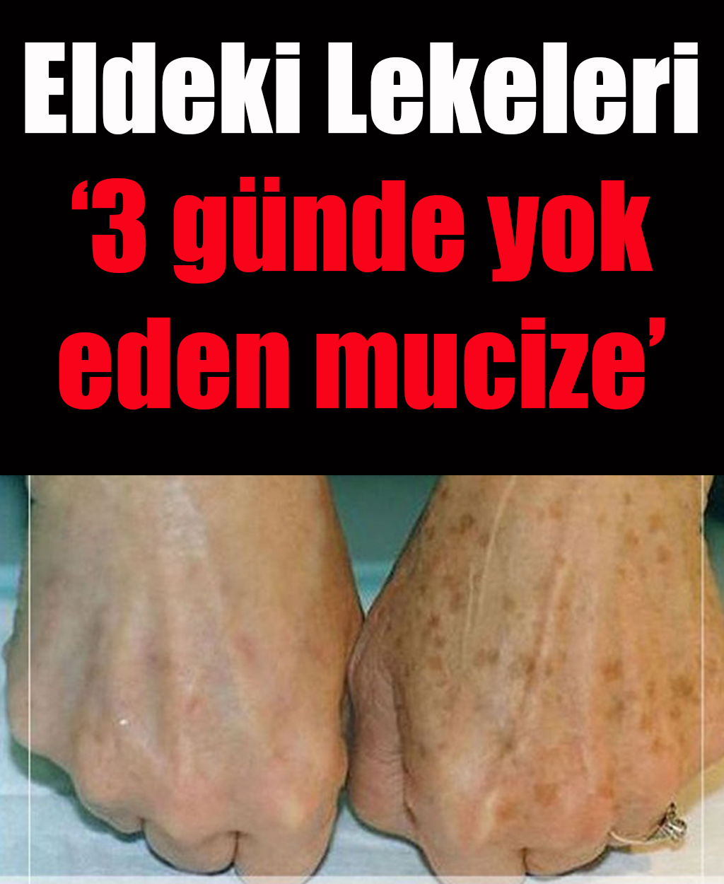 Eldeki lekeleri 3 günde yok eden mucize	 - 1