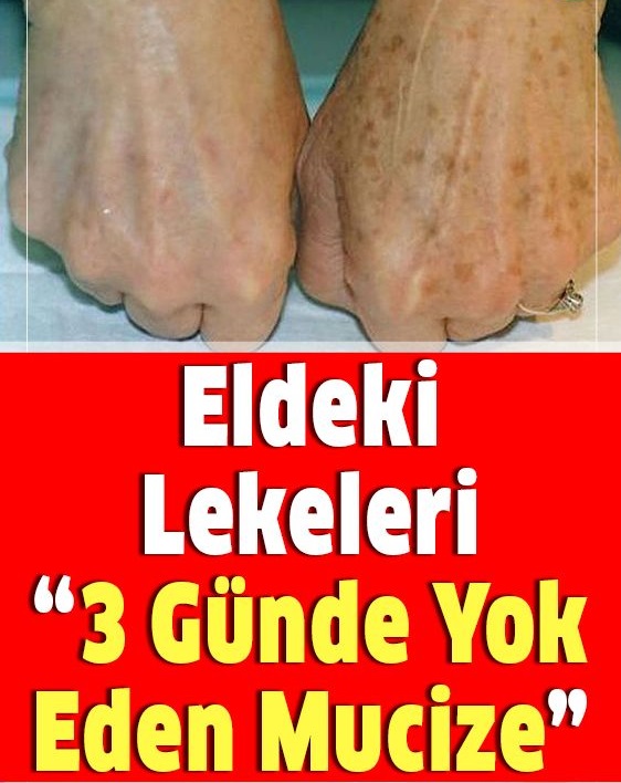 Eldeki lekeleri 3 günde yok eden mucize - 1