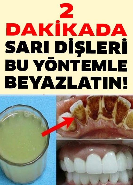 2 Dakikada Sarı Dişleri Bu Yöntemle Beyazlatın ve Ağız Kokusunu Yok Edin - 1