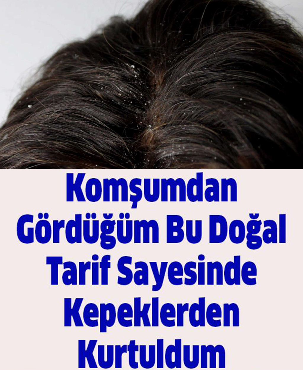 Saçlarda Oluşan Kepeğe Doğal Çözüm - 1