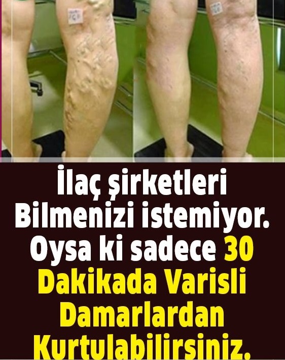 Varisli Damarlardan Sonsuza Dek Kurtaran Karışım - 1