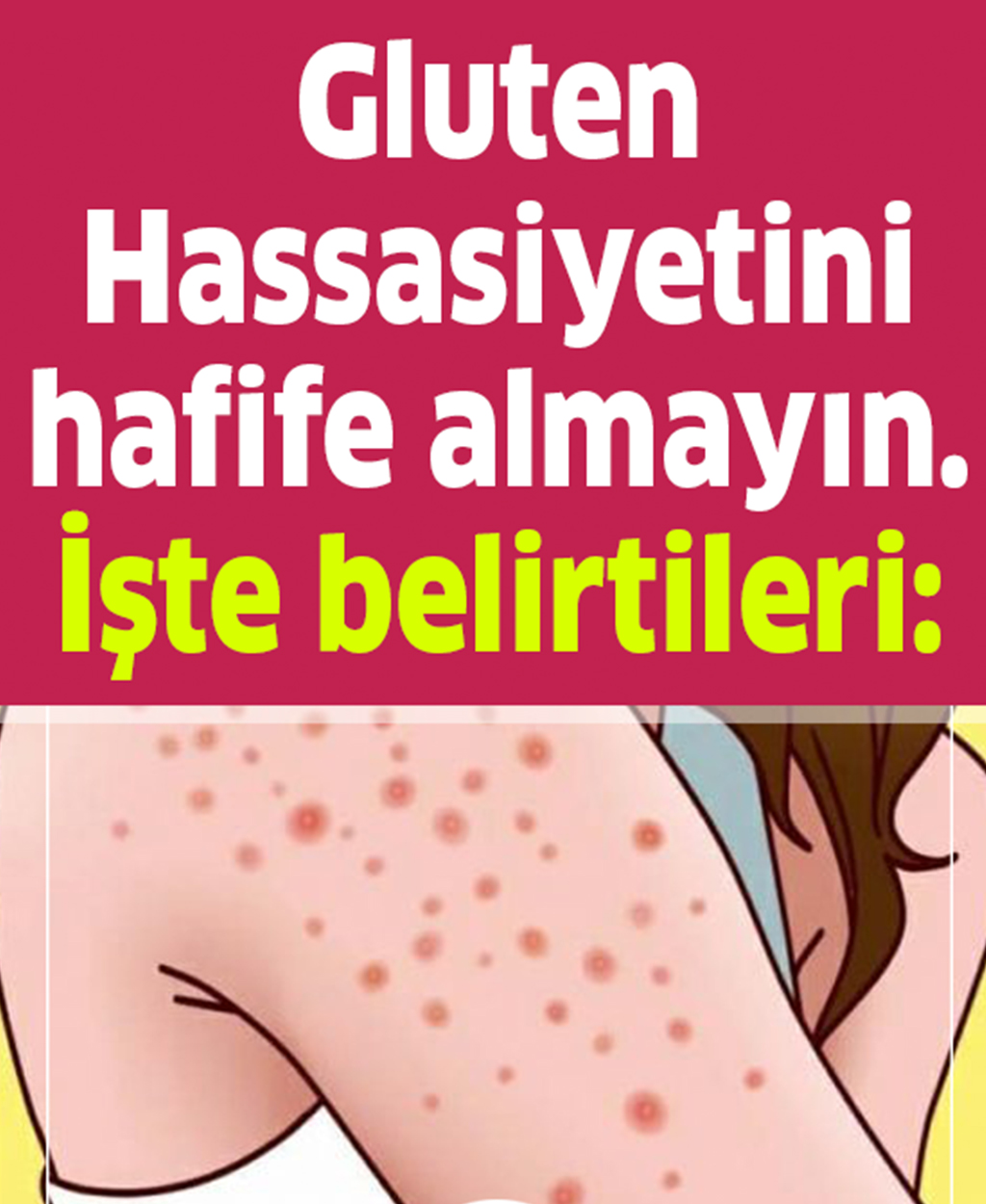 Gluten Hassasiyetini Hafife Almayın İşte Belirtileri - 1