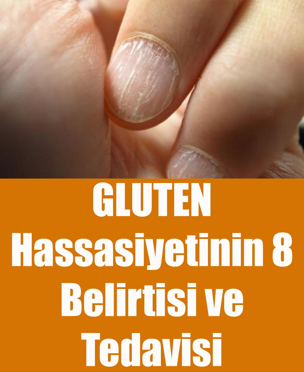 Gluten Hassasiyetinin 8 Belirtisi ve Tedavisi	 - 1