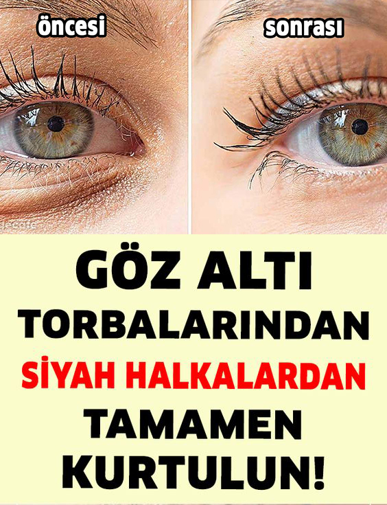 Göz Altı Torbalarından ve Siyah Halkalardan Tamamen Kurtulun - 1