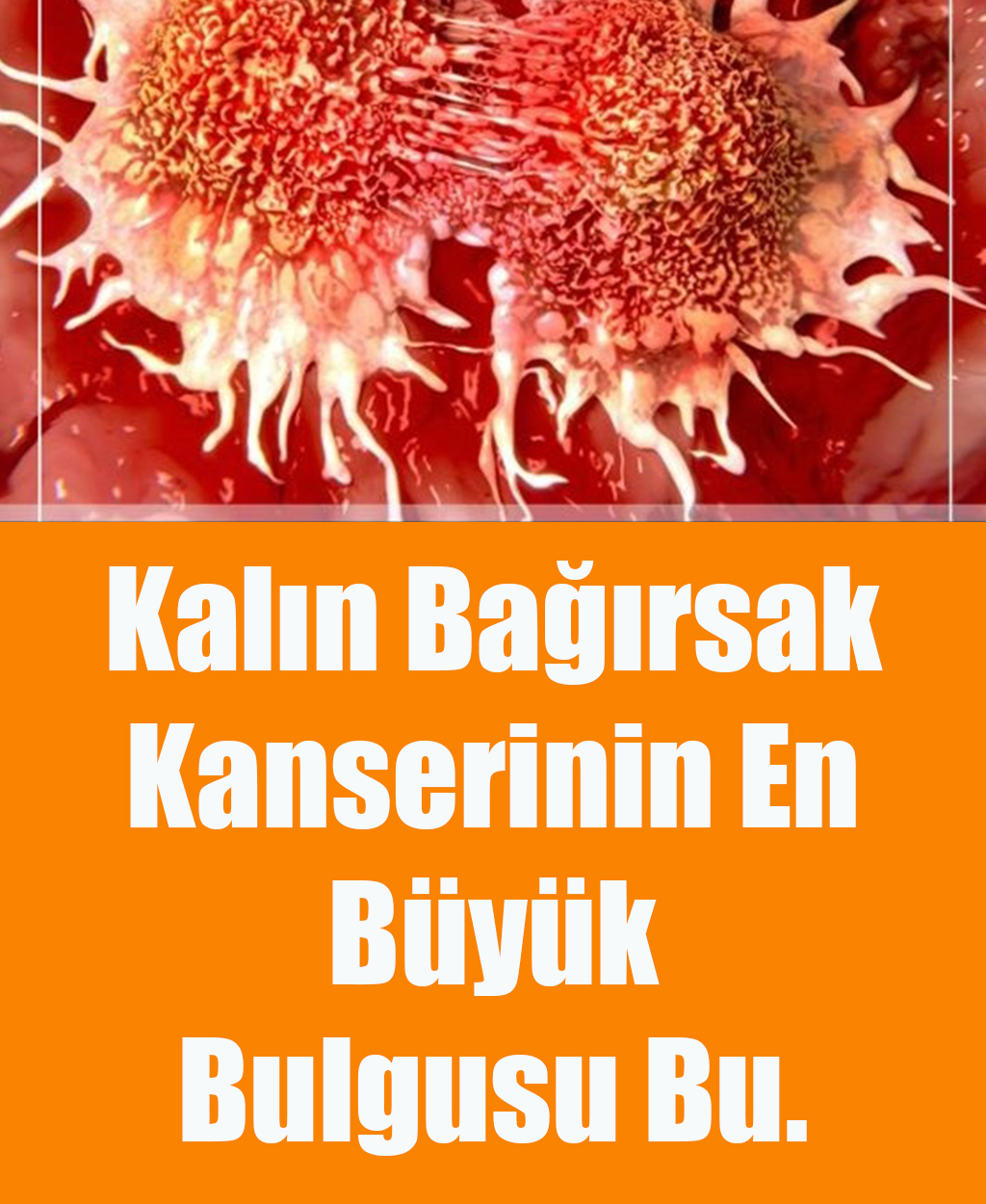Kalın Bağırsak Kanserinin En Büyük Bulgusu - 1
