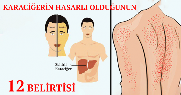 Karaciğerin Çalışmadığına Dair 12 Belirti - 2