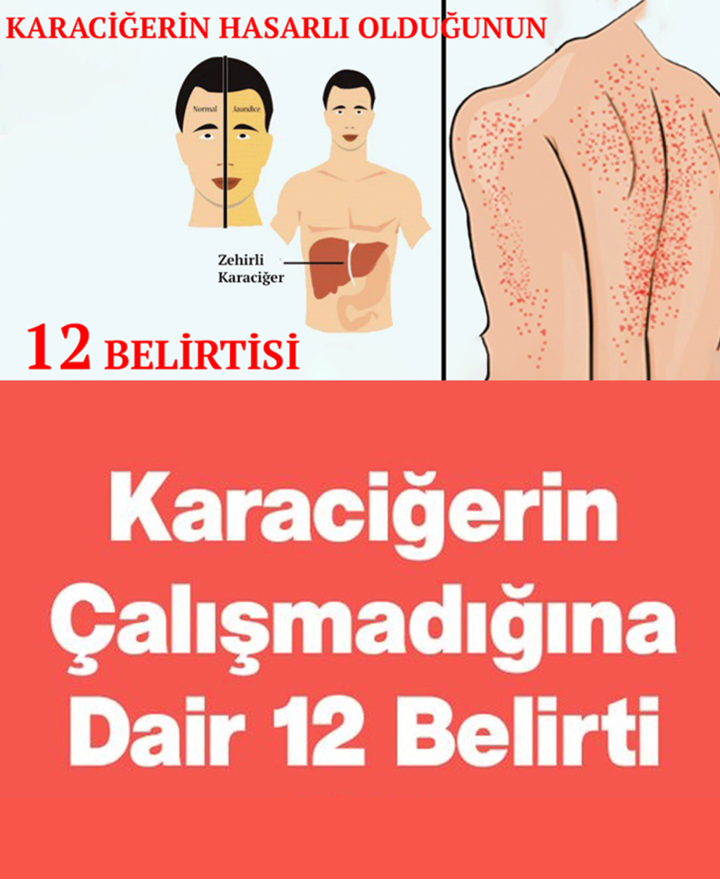 Karaciğerin Çalışmadığını Gösteren 12 Belirti	 - 1