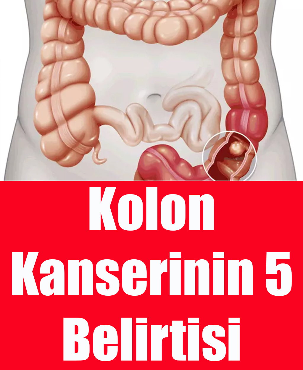 Kolon Kanserinin 5 Belirtisi - 1