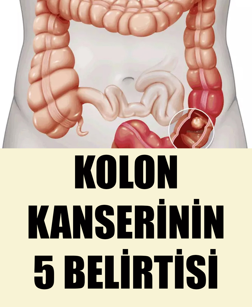Kolon Kanserinin 5 Belirtisi - 1