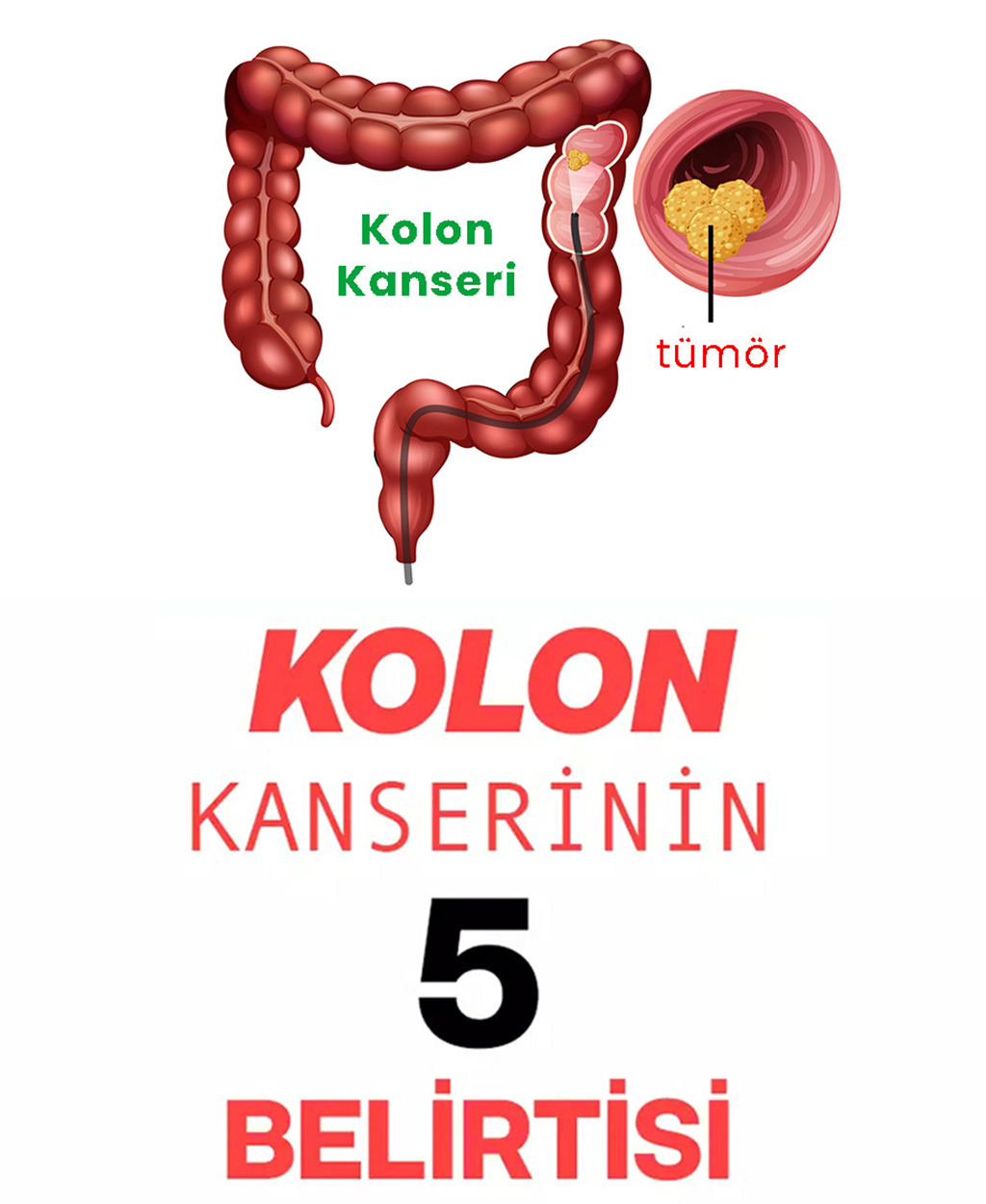 Kolon Kanserinin 5 Belirtisi - 1