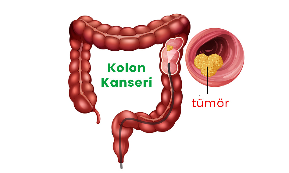 Kolon Kanserinin 5 Belirtisi - 2